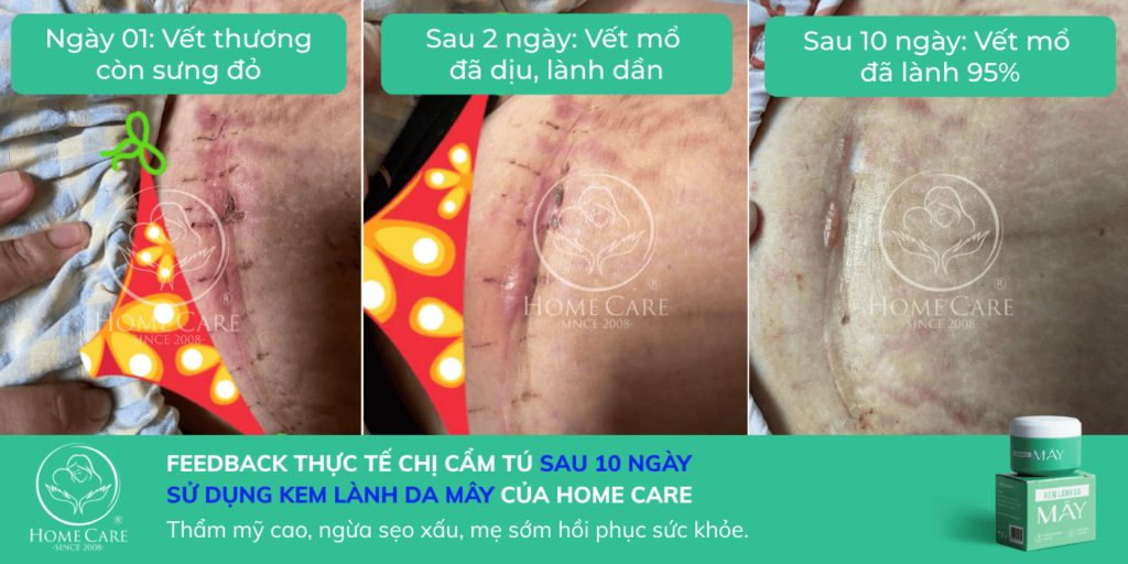 hieu-qua-su-dung-kem-lanh-da-may-mau-lanh-vet-mo