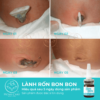 FEEDBACK-LANH-RON-BONBON-2025-a1 (1) dung-dich-lanh-ron-bonbon_lanh-ron-som-rung-ron-homecare (2)