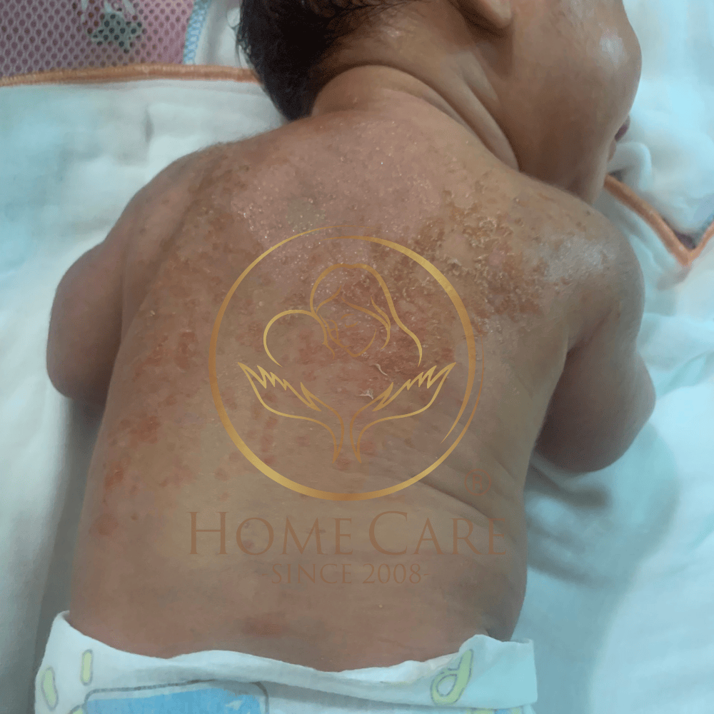 be-so-sinh-bi-rom-say