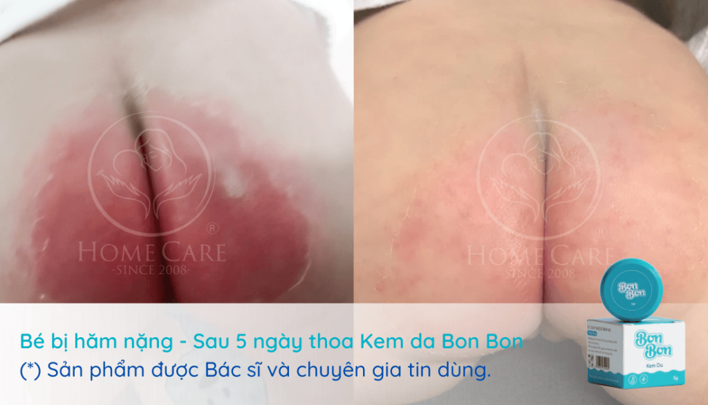 kem-tri-ham-ta-nang-cho-be-bonbon-duoc-bac-si-tin-dung